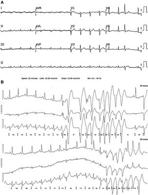 Case report: Myocarditis with nonsustained ventricular tachycardia following COVID-19 mRNA vaccination in a female adolescent